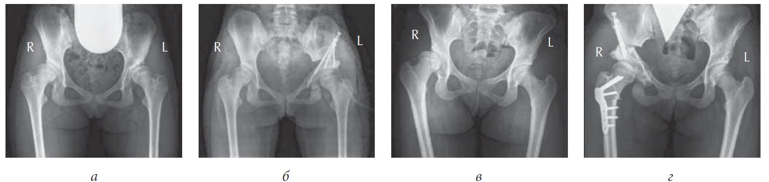 Операция тазобедренного сустава 1 степени. Рентгенография тазобедренного сустава в 1 проекции. Диспластический коксартроз 1-2 степень. Коксартроз 2 степени рентген. Диспластический коксартроз тазобедренного сустава рентген.